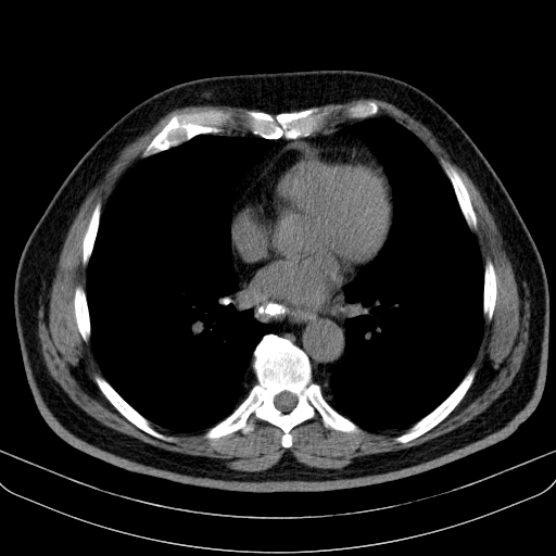 File:Classic complicated silicosis (Radiopaedia 49720-54961 Axial liver window 34).jpg