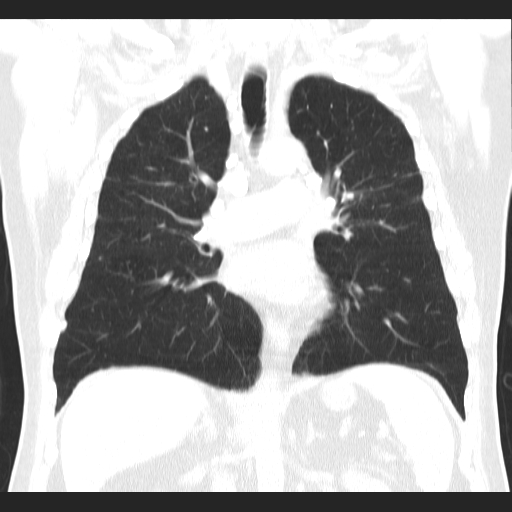File:Classic complicated silicosis (Radiopaedia 49720-54961 Coronal lung window 32).jpg
