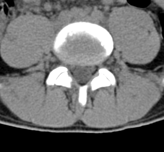 Clear cell meningoma - lumbar spine (Radiopaedia 60116-67691 Axial non-contrast 55).png