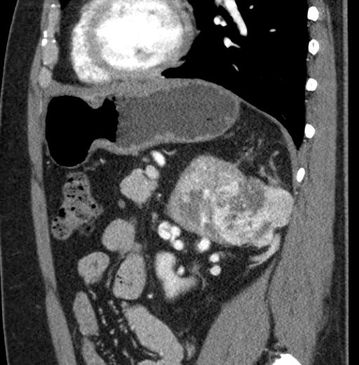 File:Clear cell renal cell carcinoma (Radiopaedia 61449-69393 D 33).jpg