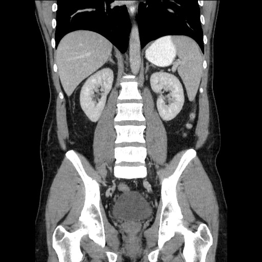 File:Closed-loop small bowel obstruction (Radiopaedia 73713-84509 C 79).jpg