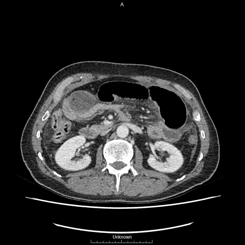 Closed loop bowel obstruction and ischemia (Radiopaedia 86959-103180 A 30).jpg