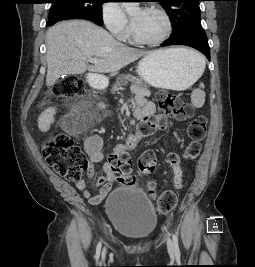Closed loop obstruction - internal hernia into nephrectomy bed (Radiopaedia 59867-67320 B 53).jpg