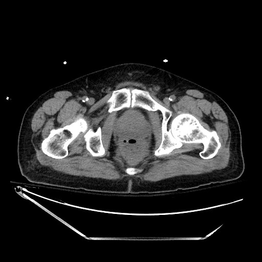 File:Closed loop obstruction due to adhesive band, resulting in small bowel ischemia and resection (Radiopaedia 83835-99023 Axial non-contrast 153).jpg