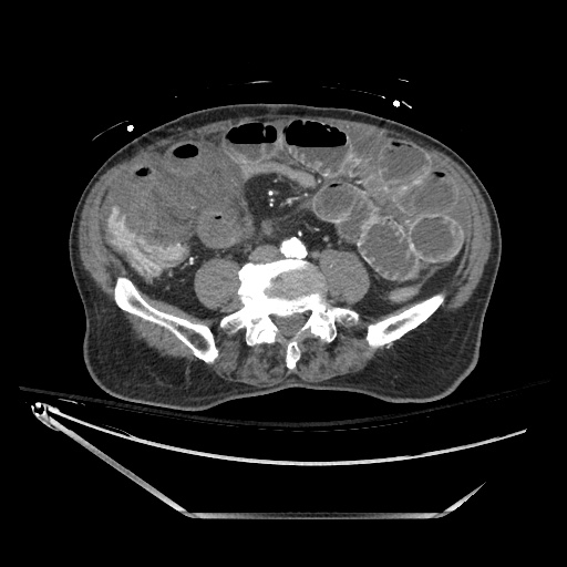 File:Closed loop obstruction due to adhesive band, resulting in small bowel ischemia and resection (Radiopaedia 83835-99023 B 95).jpg