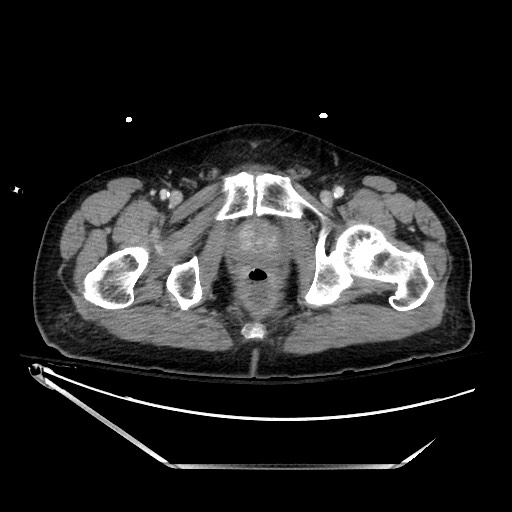 File:Closed loop obstruction due to adhesive band, resulting in small bowel ischemia and resection (Radiopaedia 83835-99023 D 155).jpg