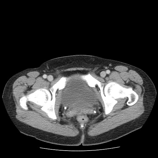 File:Closed loop small bowel obstruction (Radiopaedia 65403-74451 A 78).jpg
