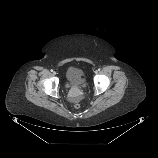 Closed loop small bowel obstruction - internal hernia (Radiopaedia 65402-74450 A 122).jpg