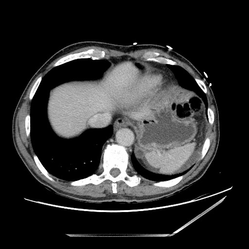 File:Closed loop small bowel obstruction - omental adhesion causing "internal hernia" (Radiopaedia 85129-100682 A 16).jpg