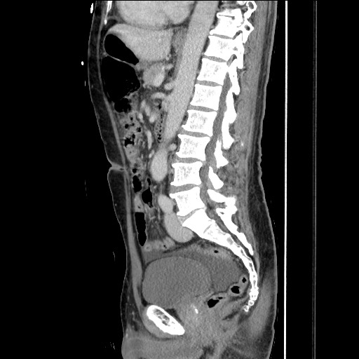 File:Closed loop small bowel obstruction - omental adhesion causing "internal hernia" (Radiopaedia 85129-100682 C 99).jpg