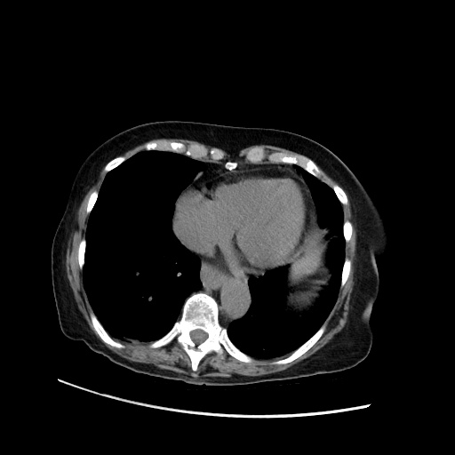 File:Closed loop small bowel obstruction due to adhesive band, with intramural hemorrhage and ischemia (Radiopaedia 83831-99017 Axial non-contrast 21).jpg