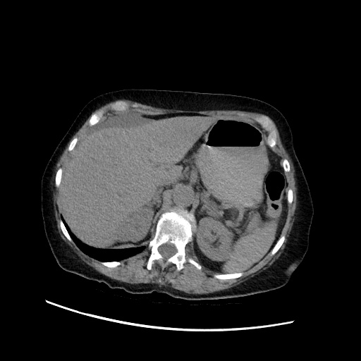 Closed loop small bowel obstruction due to adhesive band, with intramural hemorrhage and ischemia (Radiopaedia 83831-99017 Axial non-contrast 45).jpg