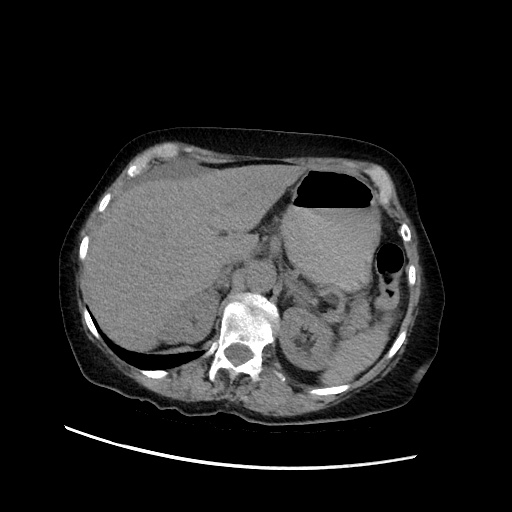 Closed loop small bowel obstruction due to adhesive band, with intramural hemorrhage and ischemia (Radiopaedia 83831-99017 Axial non-contrast 46).jpg