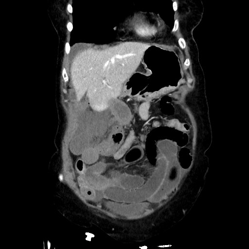 File:Closed loop small bowel obstruction due to adhesive band, with intramural hemorrhage and ischemia (Radiopaedia 83831-99017 C 33).jpg
