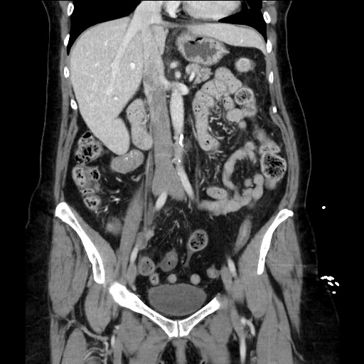Closed loop small bowel obstruction due to adhesive bands - early and late images (Radiopaedia 83830-99014 B 60).jpg