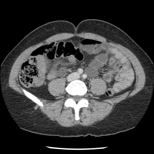 Closed loop small bowel obstruction due to trans-omental herniation (Radiopaedia 35593-37109 A 53).jpg