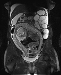 File:Closed loop small bowel obstruction in pregnancy (MRI) (Radiopaedia 87637-104031 Coronal T2 fat sat 27).jpg