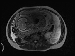 Closed loop small bowel obstruction in pregnancy (MRI) (Radiopaedia 87637-104031 D 5).jpg