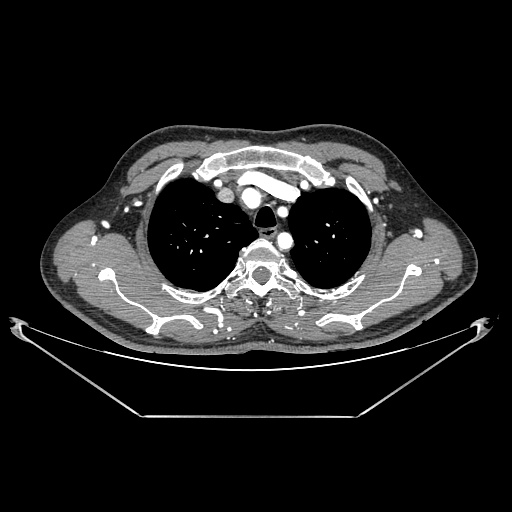 Coarctation of aorta (Radiopaedia 25384-25630 A 26).jpg