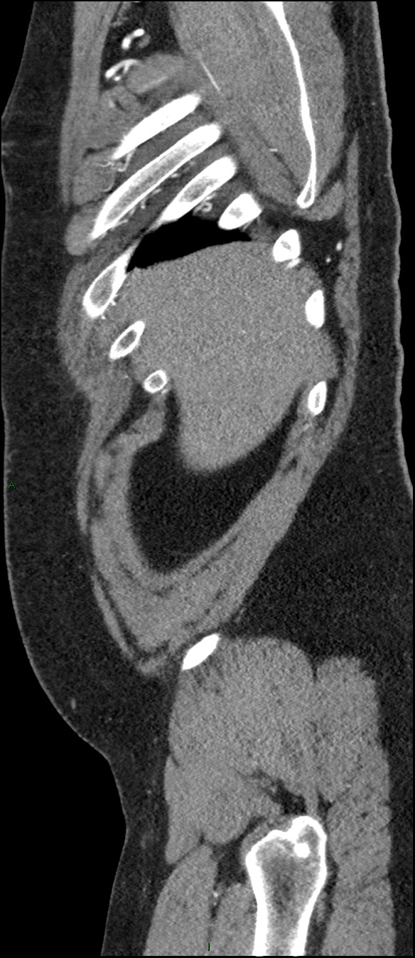 Coarctation of the aorta (Radiopaedia 74632-88521 C 25).jpg