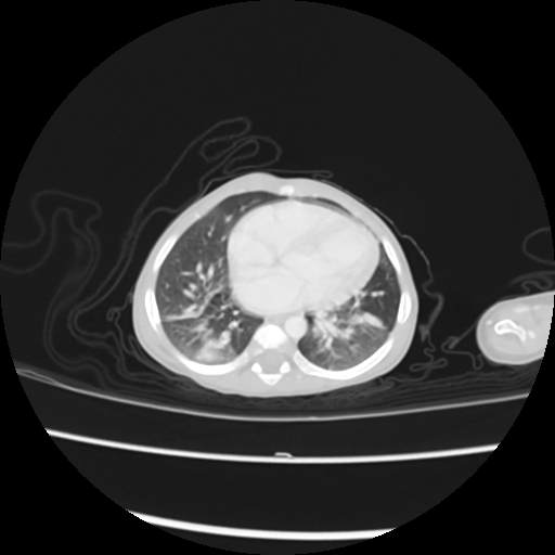 Coarctation of the aorta and patent ductus arteriosus (Radiopaedia 68033-77499 Axial lung window 39).jpg