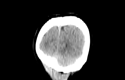 Colloid cyst (Radiopaedia 88663-105373 Coronal non-contrast 64).jpg