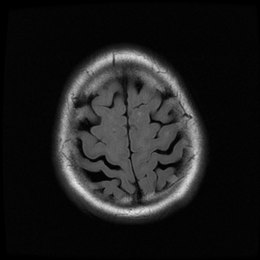 File:Colloid cyst (large) (Radiopaedia 34415-35729 Axial FLAIR 20).png