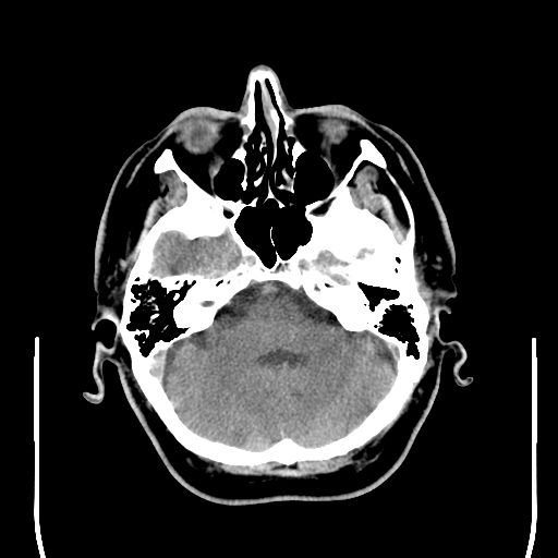 File:Colloid cyst (large) (Radiopaedia 34415-35734 Axial non-contrast 16).png
