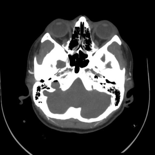 File:Colloid cyst (resulting in death) (Radiopaedia 33423-34499 A 12).png