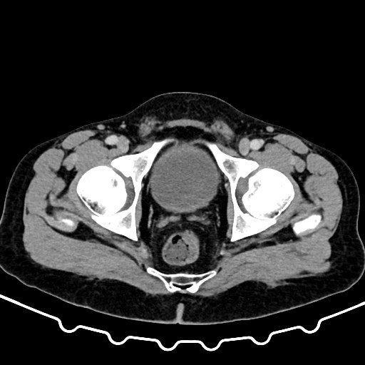 Colocolic intussusception due to large lipoma (Radiopaedia 68773-78482 A 183).jpg