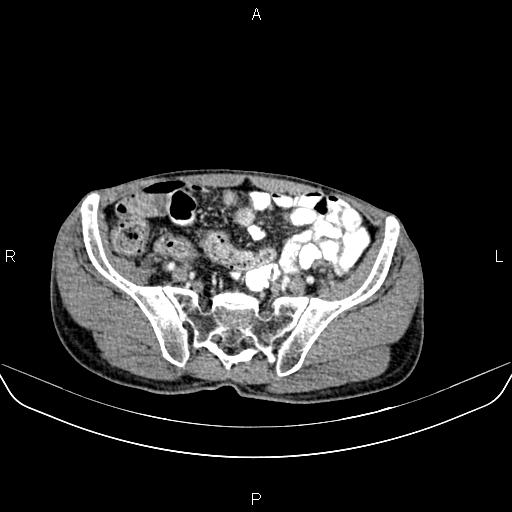 Colon adenocarcinoma - hepatic flexure (Radiopaedia 85635-101395 A 73).jpg