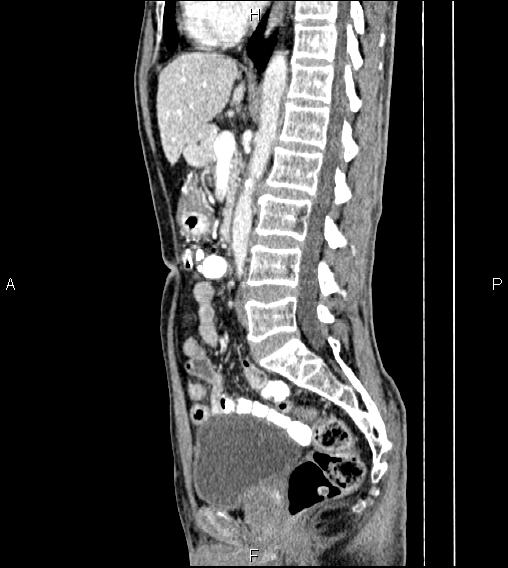 Colon adenocarcinoma - hepatic flexure (Radiopaedia 85635-101395 D 46).jpg