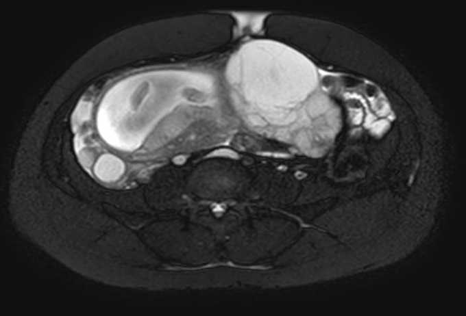 Colon adenocarcinoma with Krukenberg tumors, advanced pregnancy (Radiopaedia 67279-76645 Axial T2 SPAIR 33).jpg