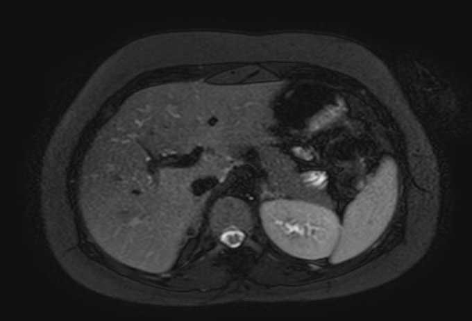 Colon adenocarcinoma with Krukenberg tumors, advanced pregnancy (Radiopaedia 67279-76645 Axial T2 SPAIR 64).jpg