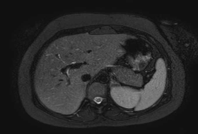 Colon adenocarcinoma with Krukenberg tumors, advanced pregnancy (Radiopaedia 67279-76645 Axial T2 SPAIR 66).jpg