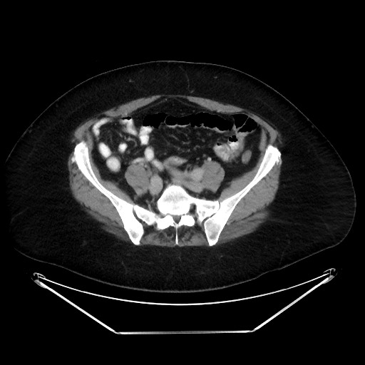 File:Colonic intussusception due to adenocarcinoma (Radiopaedia 86828-102987 A 107).jpg