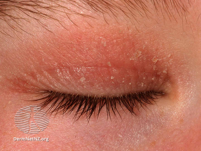 File:Eyelid eczema (DermNet NZ dermatitis-s-atopic15).jpg