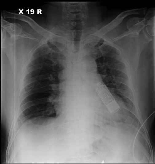 File:Implantable cardiac monitor (Radiopaedia 66974).jpg