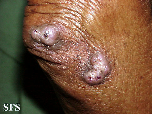 File:Keratoacanthoma (Dermatology Atlas 32).jpg