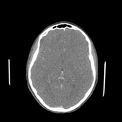 Nasal pyogenic granuloma (lobular capillary hemangioma) (Radiopaedia 85536-101244 C 109).jpg