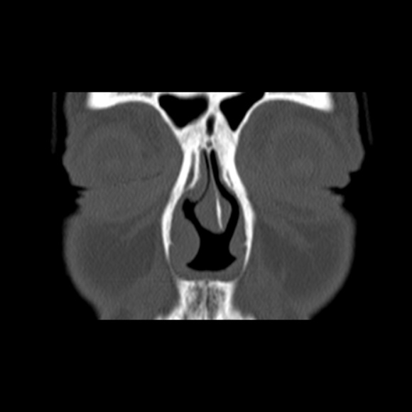 File:Nasal septal perforation (Radiopaedia 25030-25289 Coronal bone window 16).jpg