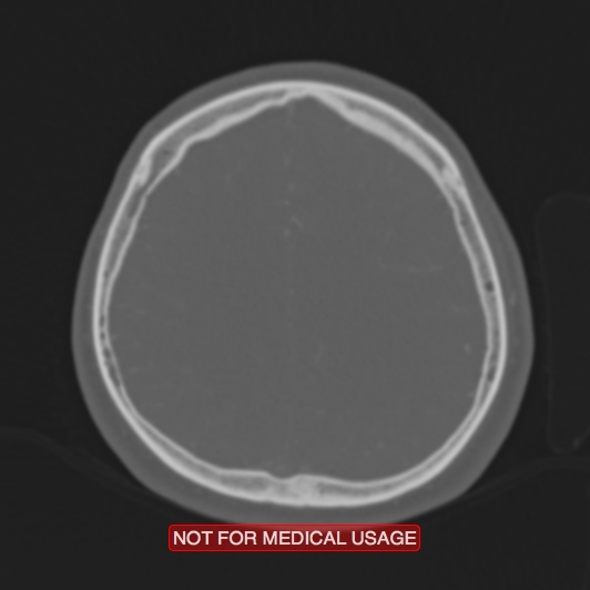 Nasopharyngeal carcinoma recurrence - skull base destruction (Radiopaedia 29107-29490 Axial bone window 30).jpg