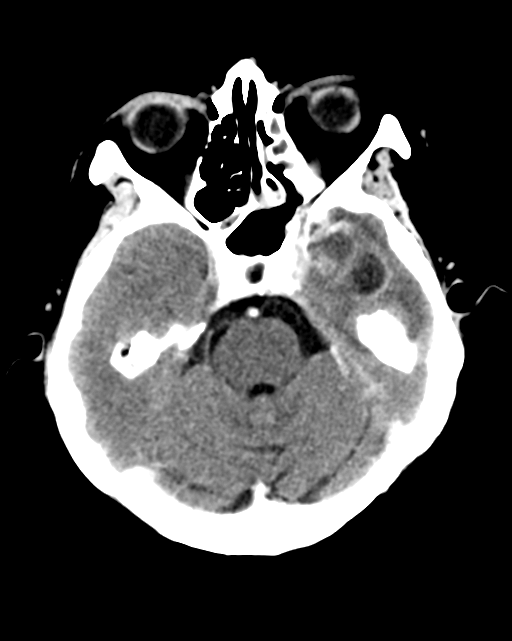 Nasopharyngeal carcinoma with cerebral abscess (Radiopaedia 43018-46275 Axial C+ delayed 17).png