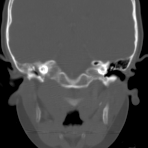File:Nasopharyngeal rhabdomyosarcoma (Radiopaedia 23417-23491 Coronal bone window 6).jpg