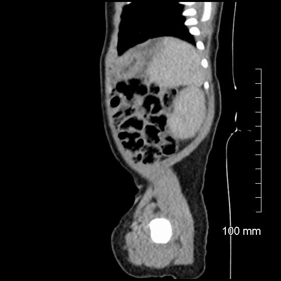 File:Neonatal neuroblastoma (Radiopaedia 56651-63438 C 22).jpg