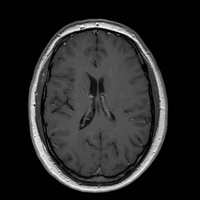 File:Neuro-Behcet's disease (Radiopaedia 21557-21506 Axial T1 C+ 17).jpg