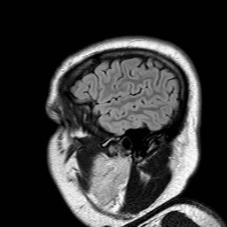 File:Neuro-Behcet's disease (Radiopaedia 21557-21506 Sagittal FLAIR 2).jpg