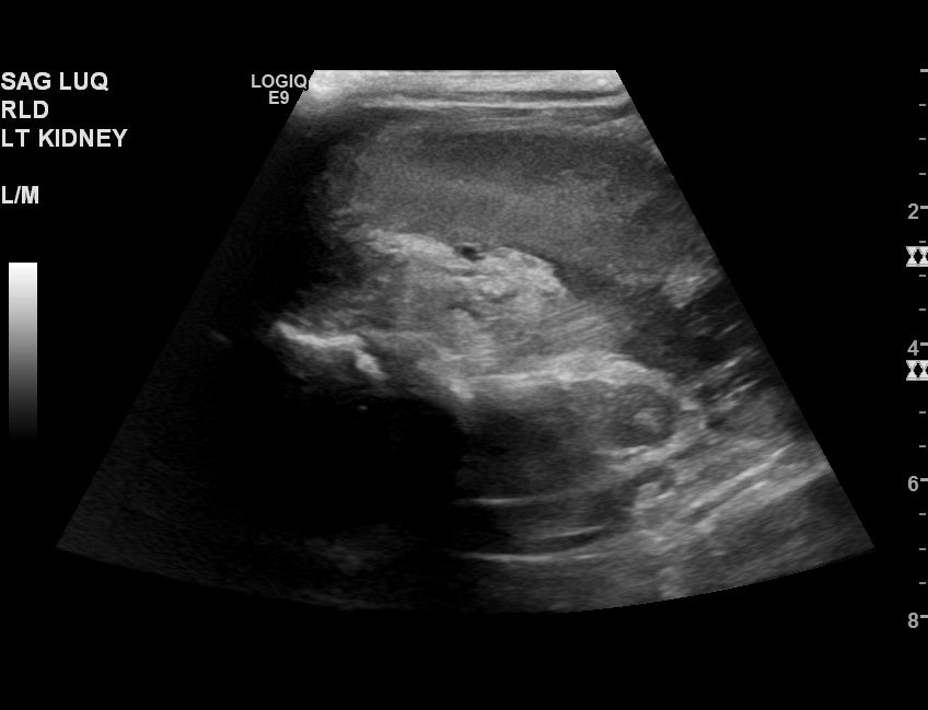 Neuroblastoma (Radiopaedia 47939-52718 Cine Clip 2).jpg