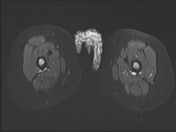 File:Neuroblastoma with bone metastases (Radiopaedia 67080-76414 Axial STIR 31).jpg