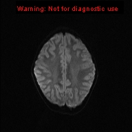 File:Neurofibromatosis type 1 with optic nerve glioma (Radiopaedia 16288-15965 Axial DWI 31).jpg